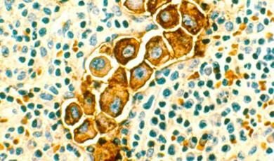 Human metastatic breast cancer cells in the lymph nodes2016-10-19 ChrisWhitty_Treatment_1920x660.jpg